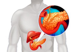 Biliary Tract Disease