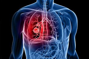 Bronchial Erlang Embolization