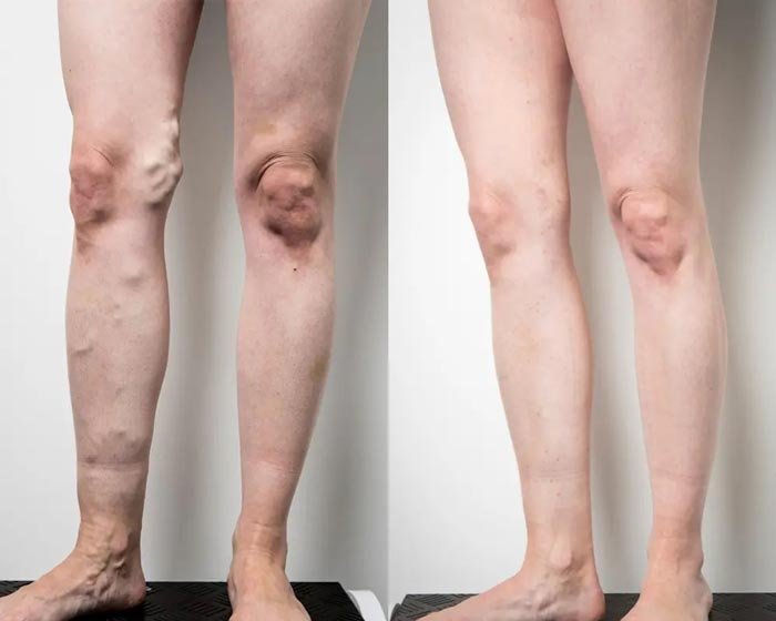 Varicose Veins