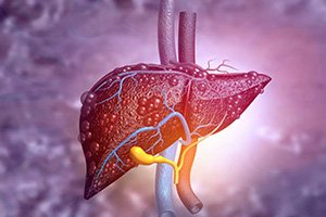 Liver Cirrhosis