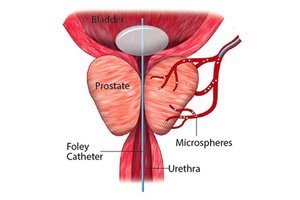 Prostateartery