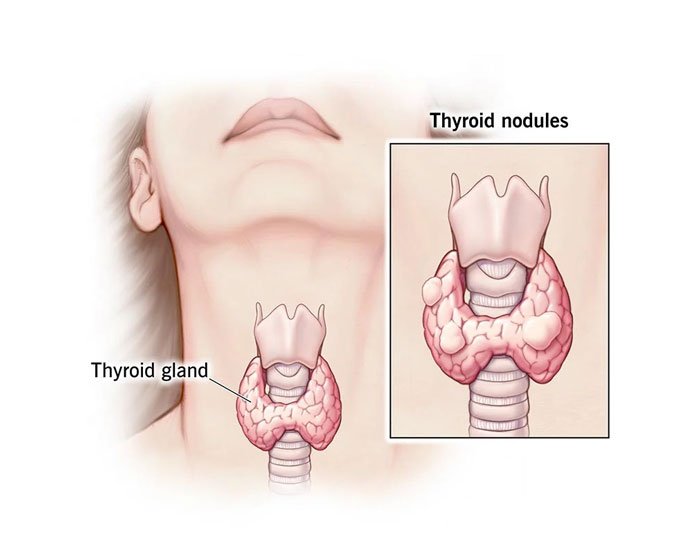 Thyroid