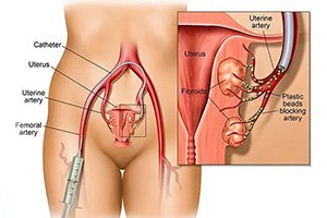 Explanation of Uterine Artery Embolization