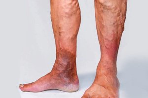 Varicose Vein