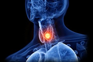 Thyroid Nodule Ablation