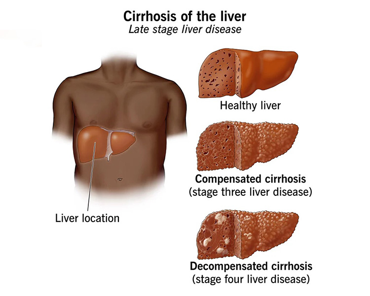 Leading Liver Cirrhosis Treatment in Bhiwandi | Liver Cirrhosis