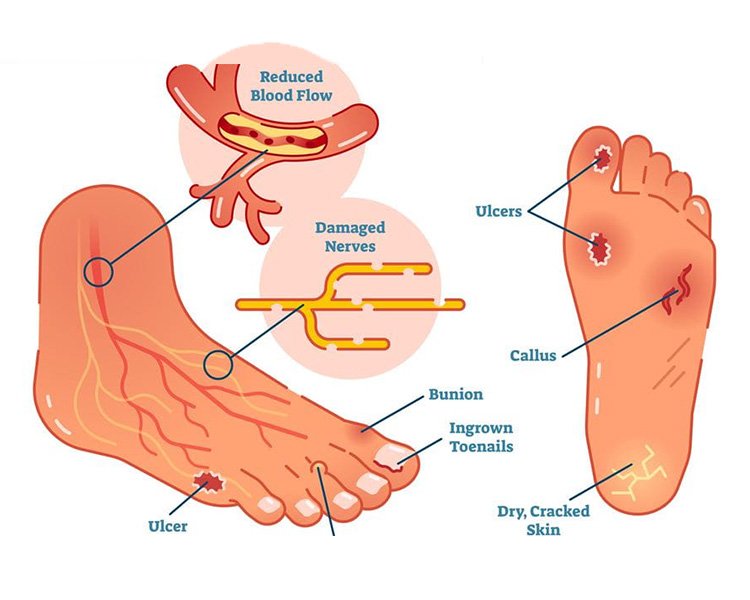 Diabetes Foot