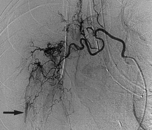 Bronchial artery angiogram