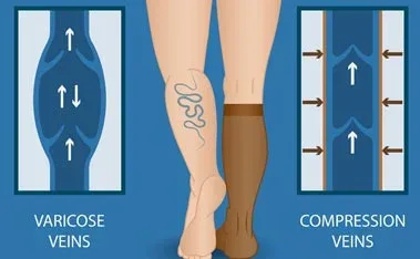 Illustration of compression stockings supporting leg veins