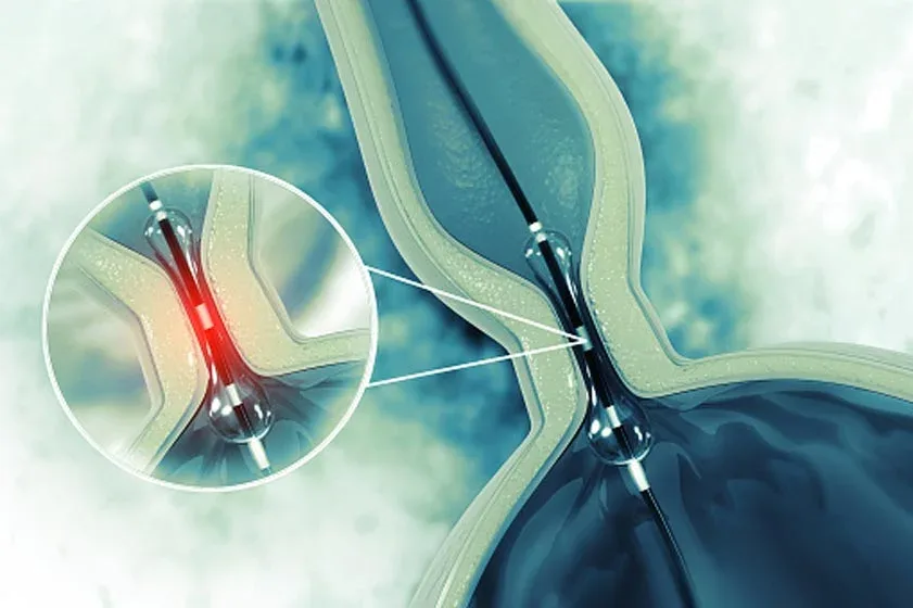 Illustration of a catheter-directed cancer treatment