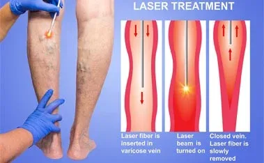 Diagram of endovenous laser treatment