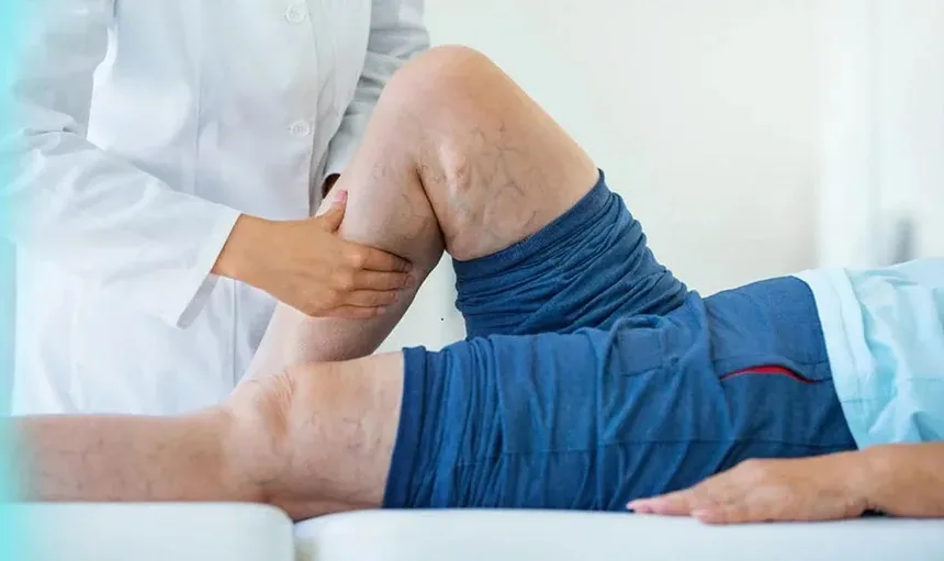 Doctor examining a patient’s leg for varicose veins
