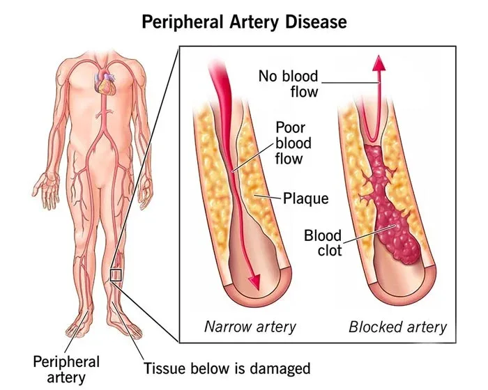 Illustration of narrowed leg arteries in peripheral arterial disease