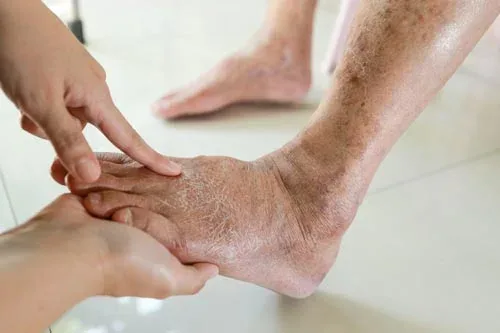 Foot examination for poor circulation