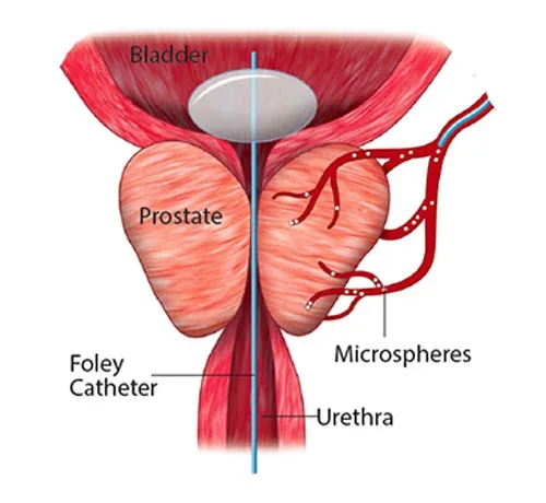 Diagram of the prostate and its arteries
