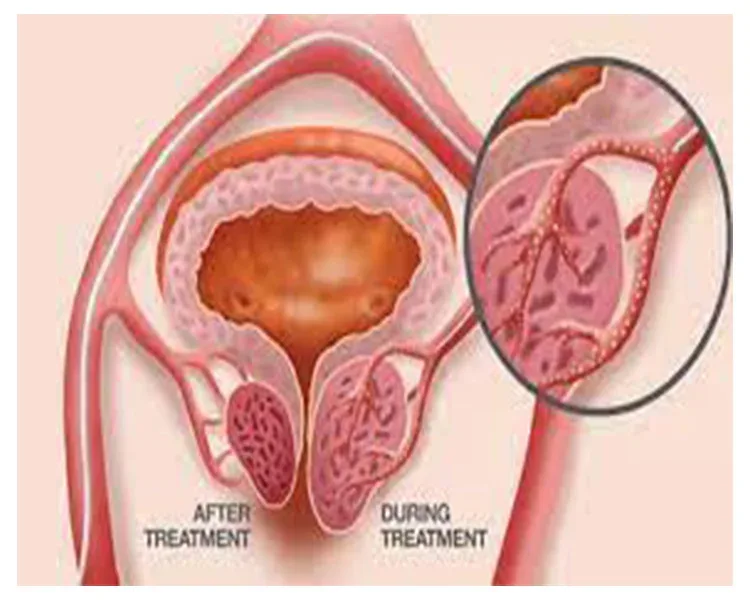 Illustration of the prostate before and after embolization