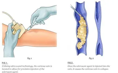 Diagram of sclerotherapy injection