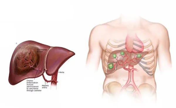 Illustration of transarterial chemoembolization