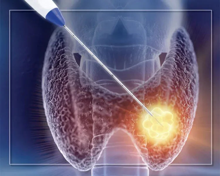 Illustration of radiofrequency ablation of a thyroid nodule
