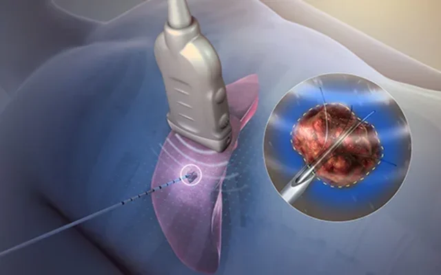 Illustration of image-guided tumour ablation