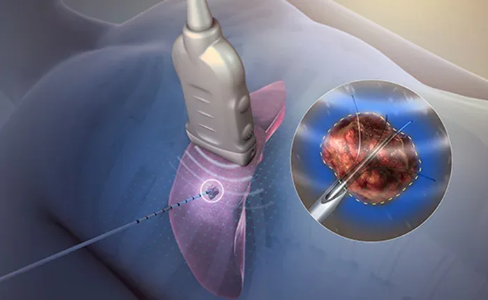 Illustration of image-guided tumour ablation