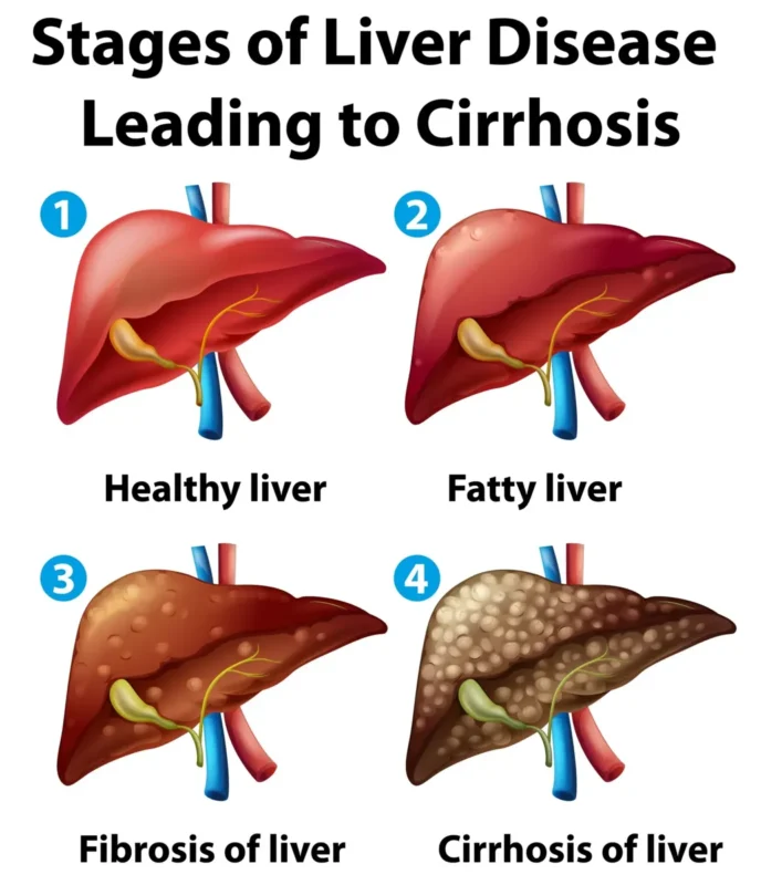 Understanding the Stages of Liver Cirrhosis