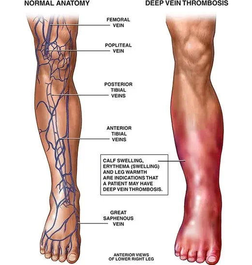 Unraveling DVT: Guarding Against Silent Threats - Dr Chandrakant
