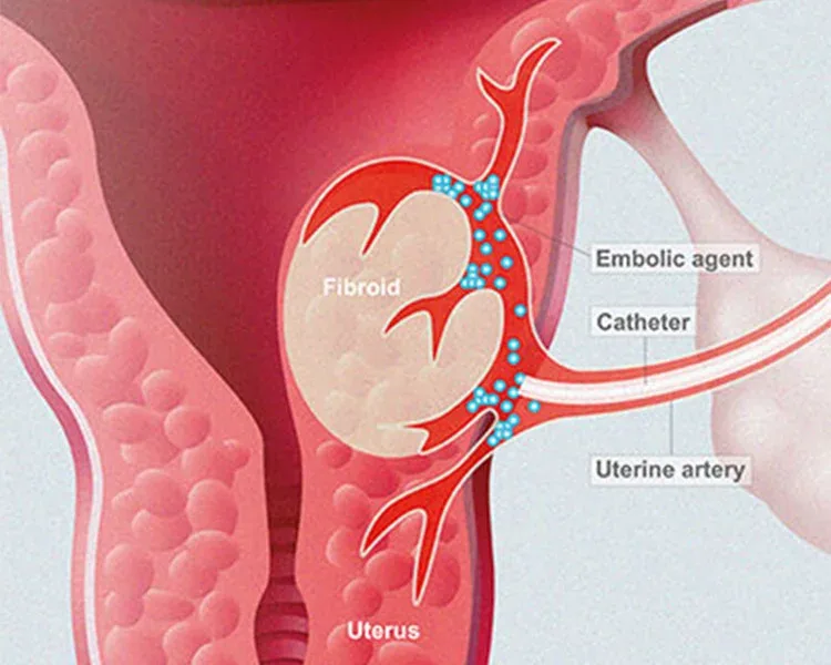 Illustration of uterine artery embolization for fibroids