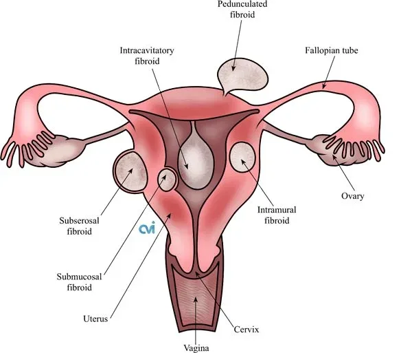 Diagram of the uterus and uterine arteries