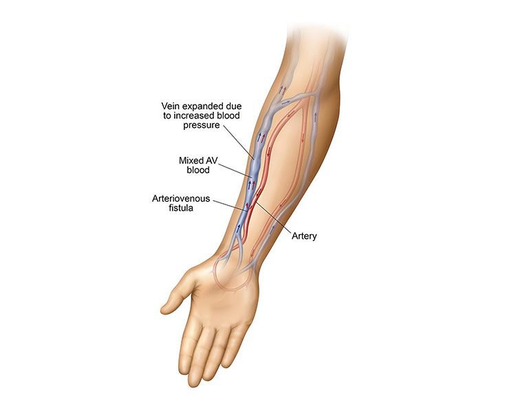 Fistula In Arm Dialysis