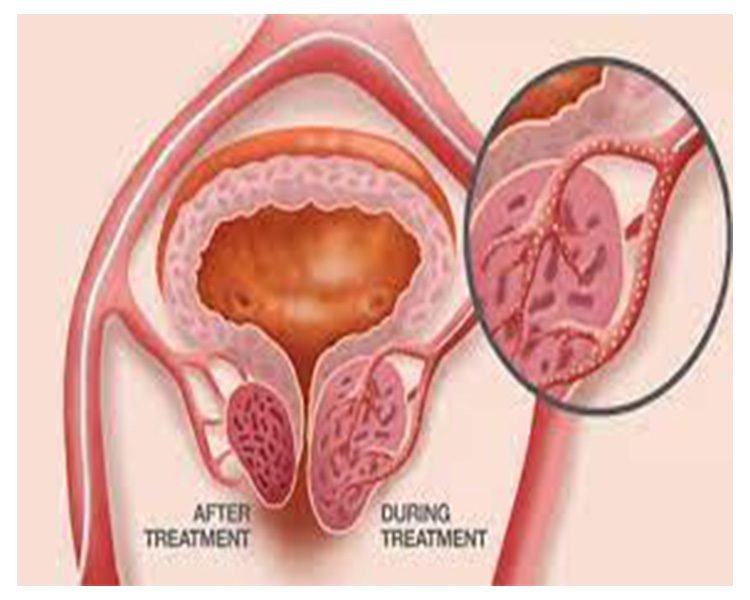 Prostate Artery Embolization